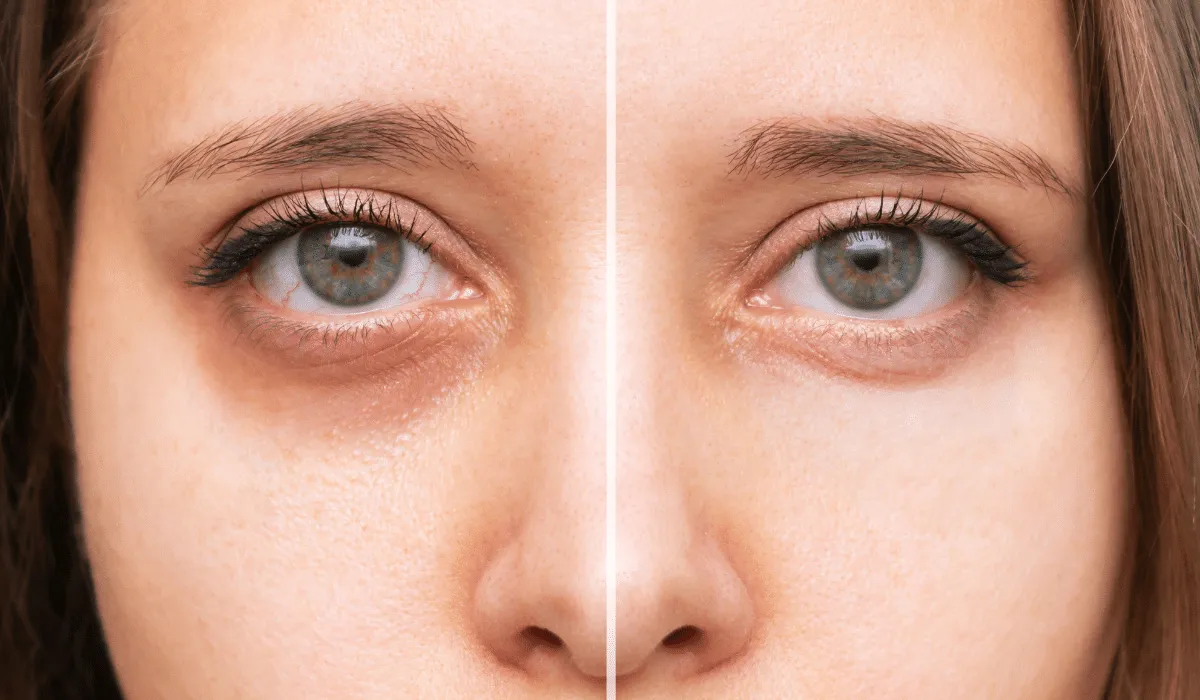 Descubre remedios rápidos y efectivos para aliviar o disimular ojos cansados. Desde bolsitas de té hasta masajes, cuida tu mirada fácilmente.