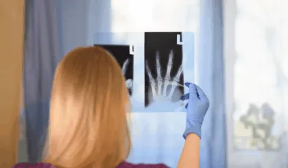 fracturas por estrés