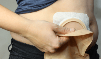 Una ostomía puede ser necesaria si una lesión o enfermedad impide que los desechos salgan del cuerpo.