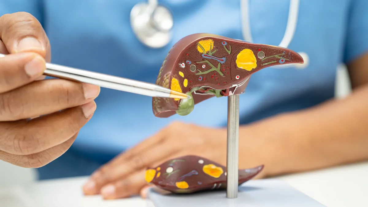 Hígado Graso No Alcohólico: 3 Remedios Naturales con Estudios que los Avalan