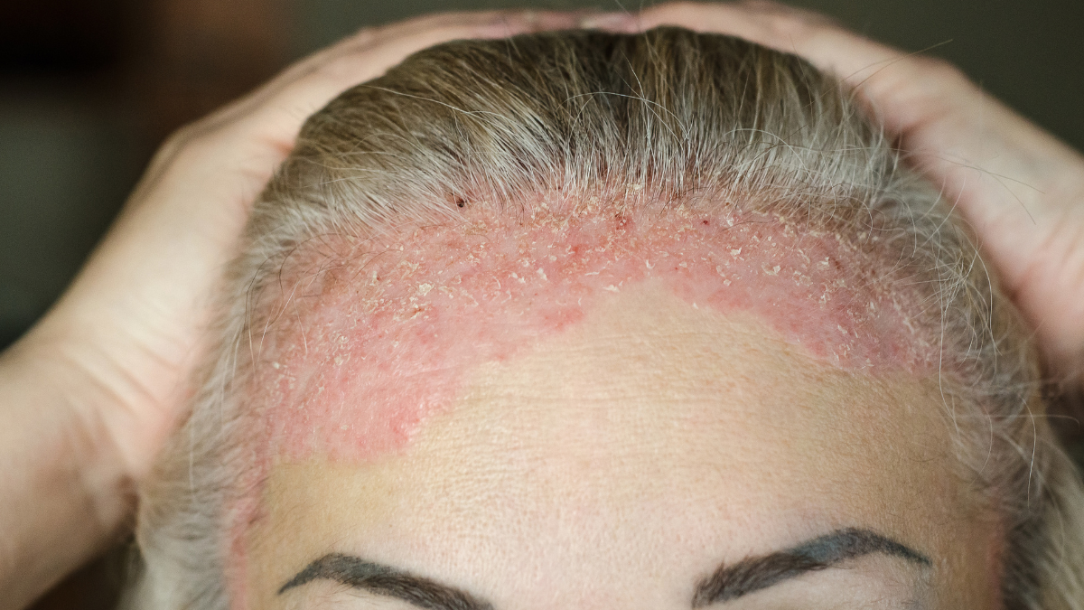 ¿Qué es la psoriasis del cuero cabelludo?