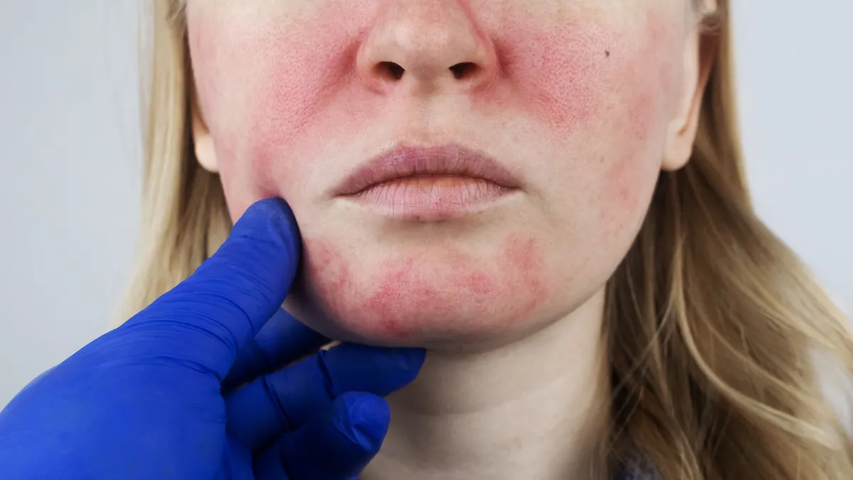 La rosácea puede confundirse con el acné, la dermatitis u otros problemas de la piel. No hay cura para esta afección, pero es posible controlarla
