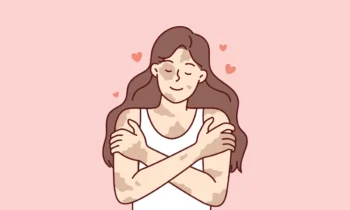 el impacto de las quemaduras en la salud emocional