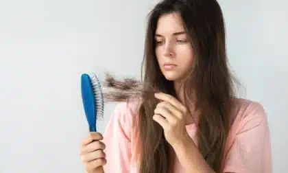 quedar calvo por estrés