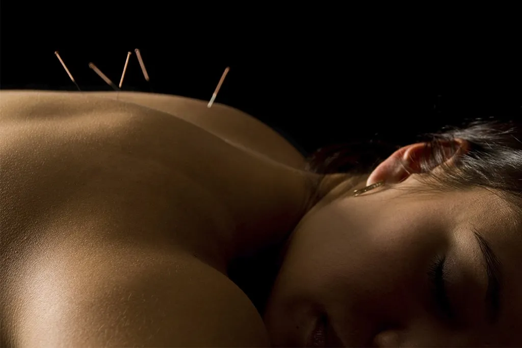 6 usos de la acupuntura que debes conocer