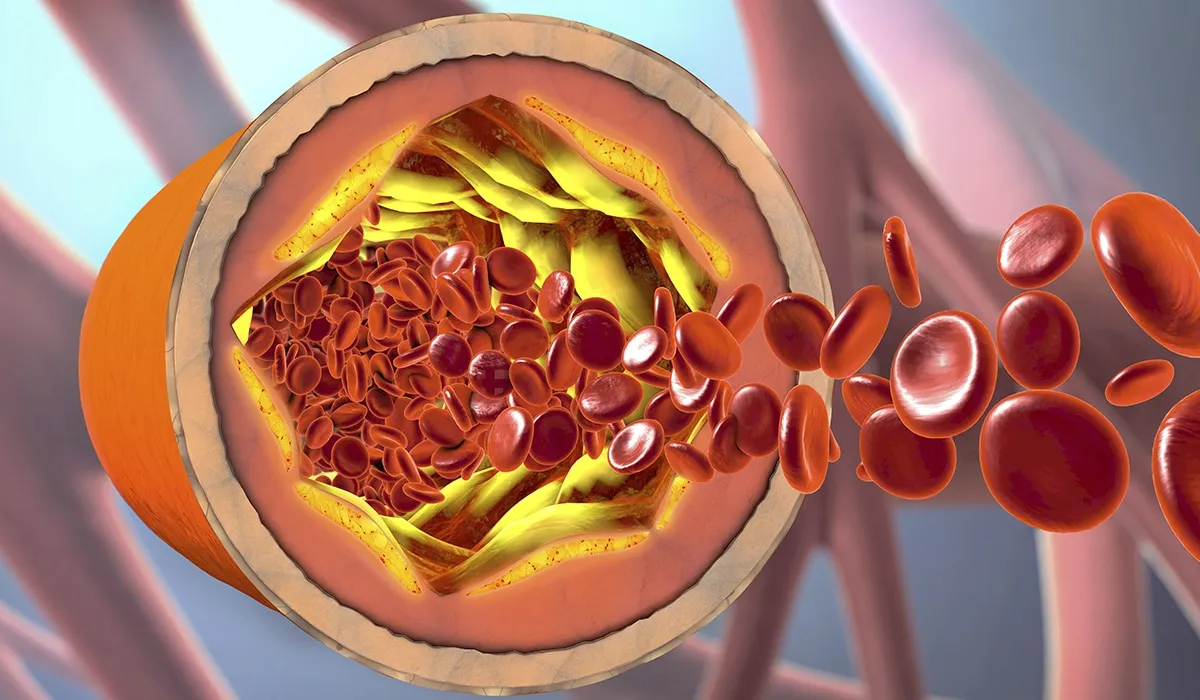 8 formas de bajar el colesterol y limpiar tus arterias