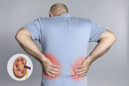 Alimentos para evitar y reducir los cálculos renales