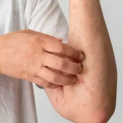 Sarampión en México: diez datos clave que no sabías sobre el brote actual