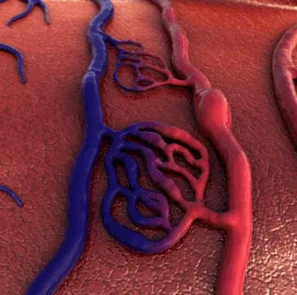 aterosclerosis
