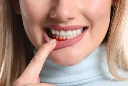 la periodontitis puede afectar tu corazón
