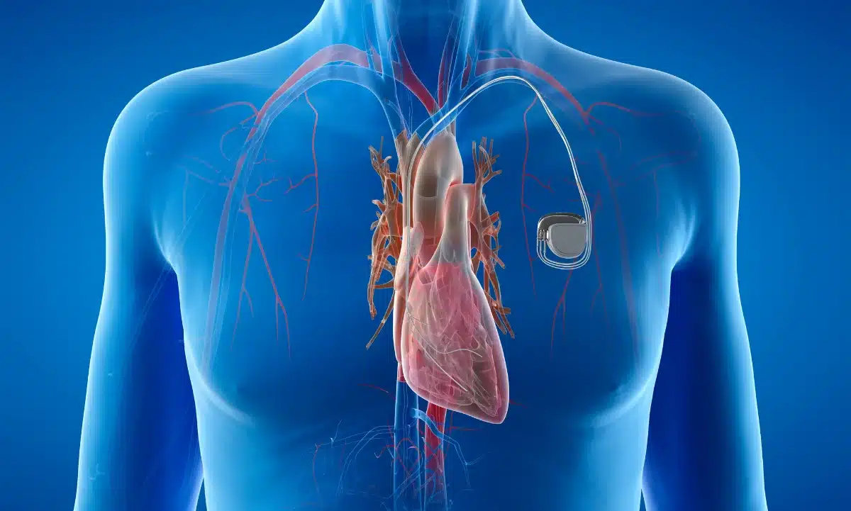 nuevo marcapasos creado por argentinos