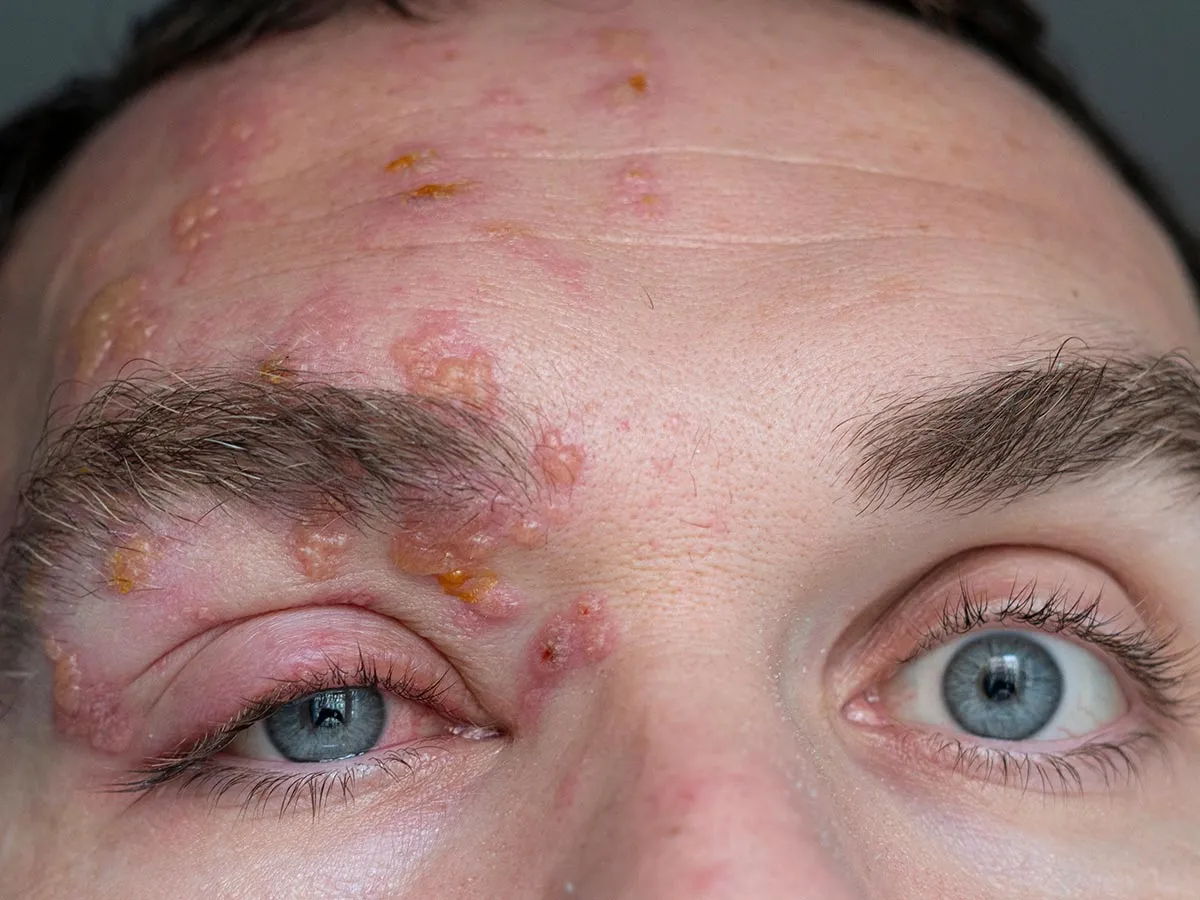 Herpes: síntomas, zonas del cuerpo que afecta y cómo se transmite